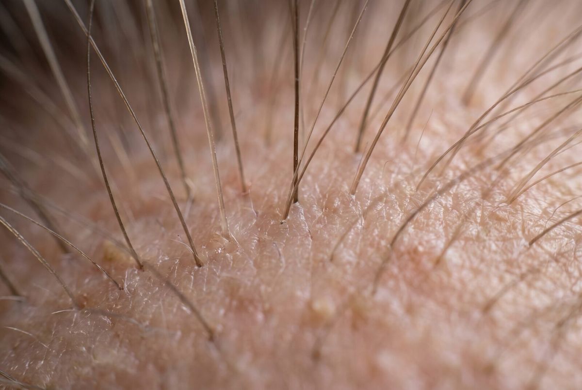 Illustrative image: extreme close view of hair growing from the scalp.